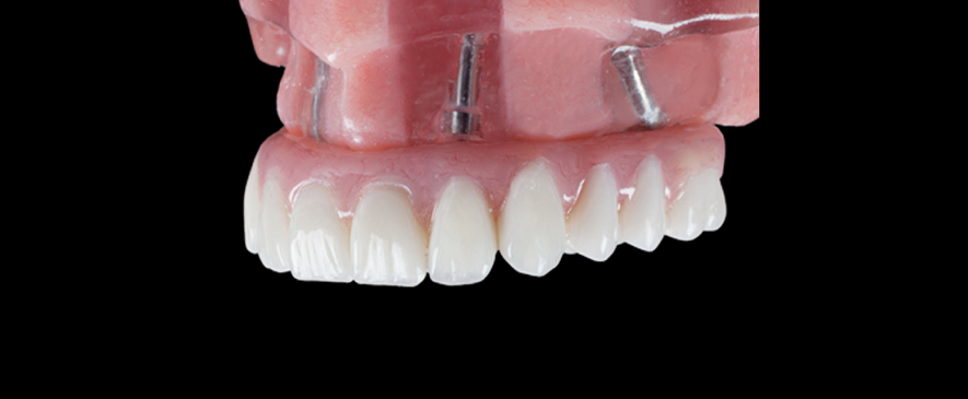 Implantes All On Four clinica dental monforte